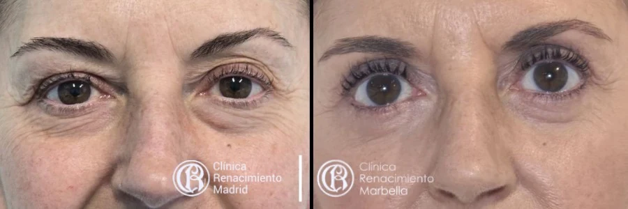 Caso real de blefaroplastia en Marbella antes y después, rejuvenecimiento de la mirada paciente 1 | Clínica Renacimiento Marbella