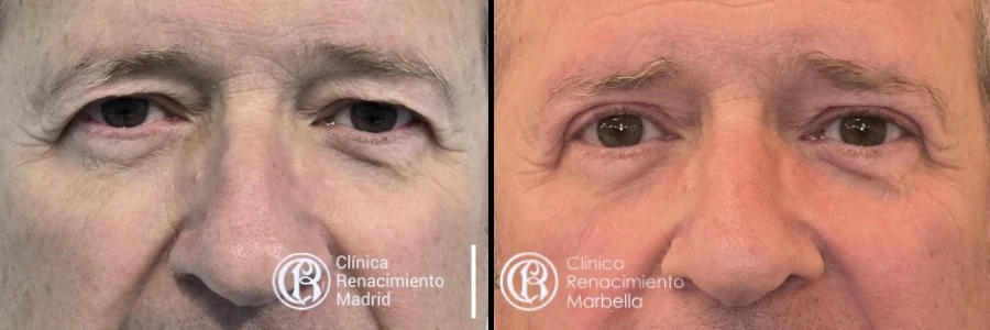 Caso real de blefaroplastia inferior y superior en Marbella paciente 3 | Clínica Renacimiento Marbella