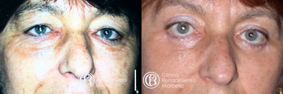 Comparativa real de blefaroplastia en Marbella antes y después paciente 4 | Clínica Renacimiento Marbella