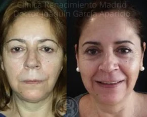 Blefaroplastia en Marbella caso real antes y después paciente 5 | Clínica Renacimiento Marbella