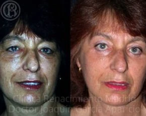 Cirugía de párpados en Marbella antes y después paciente 6 | Clínica Renacimiento Marbella