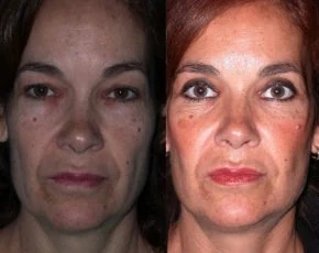Resultado de blefaroplastia en Marbella antes y después paciente 8 | Clínica Renacimiento Marbella
