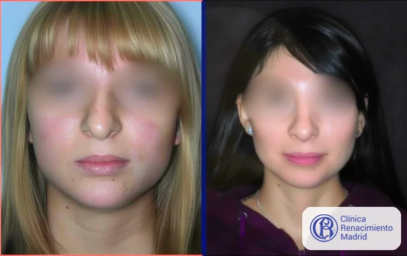 Caso real de Bichectomía / Bolas de Bichat en Marbella vista frontal antes y después | Clínica Renacimiento Marbella