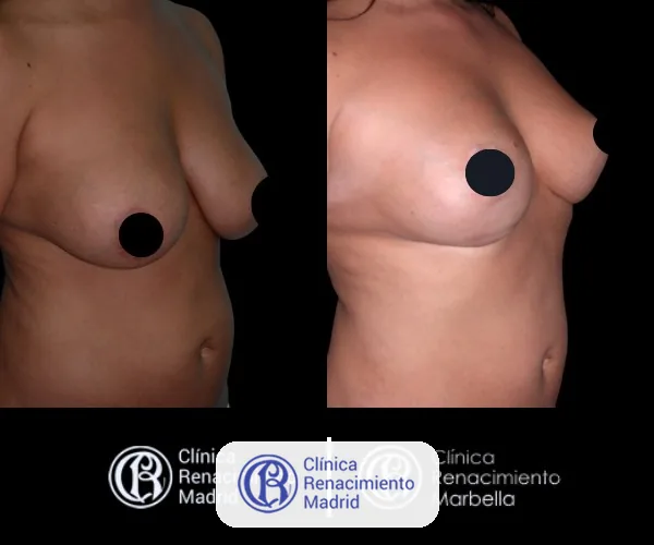 Реальный случай подтяжки груди мастопексии в Мадриде до и после пациентка 3 | Clínica Renacimiento Marbella
