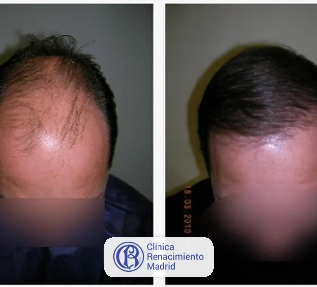 Caso real de implante de pelo en Marbella antes y después paciente 1 | Clínica Renacimiento Marbella