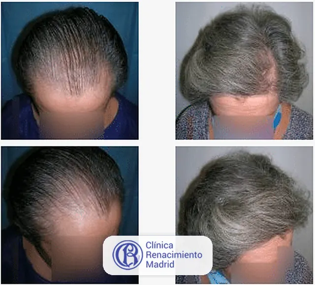Caso real de implante de pelo en Marbella antes y después paciente 2 | Clínica Renacimiento Marbella