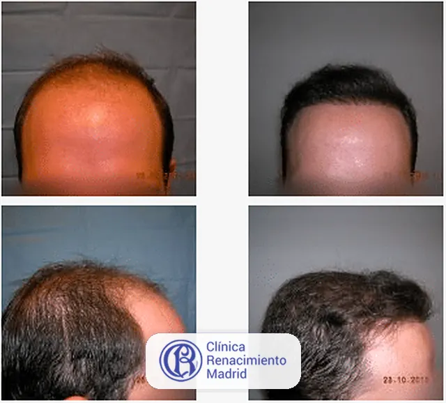 Caso real de implante de pelo en Marbella antes y después paciente 3 | Clínica Renacimiento Marbella
