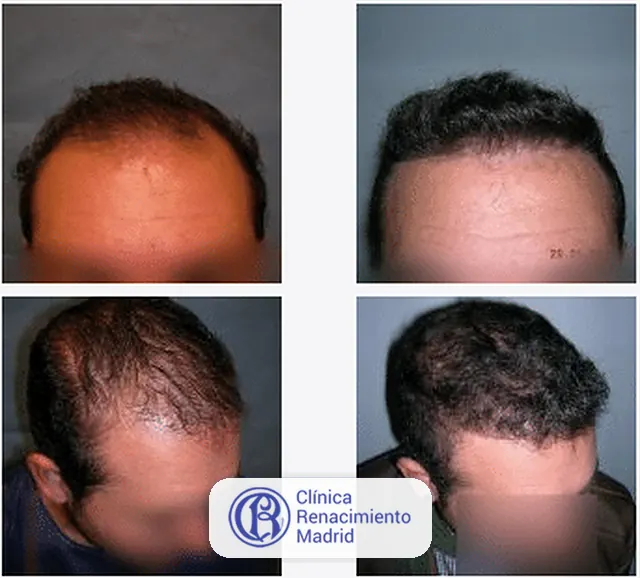 Caso real de implante de pelo en Marbella antes y después paciente 4 | Clínica Renacimiento Marbella