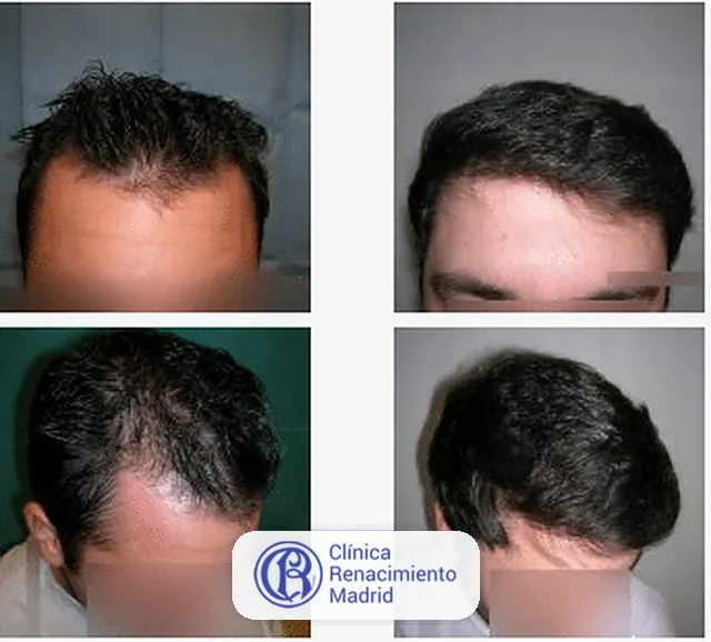 Caso real de implante de pelo en Marbella antes y después paciente 5 | Clínica Renacimiento Marbella