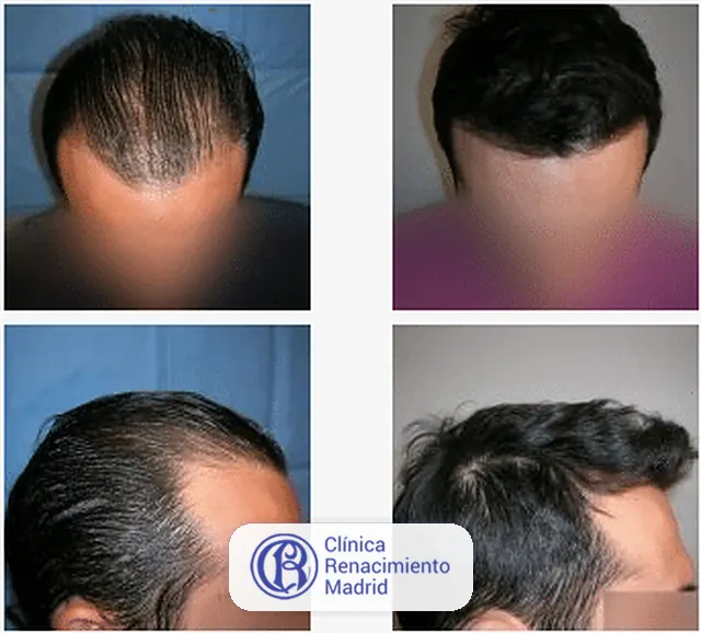 Caso real de implante de pelo en Marbella antes y después paciente 6 | Clínica Renacimiento Marbella