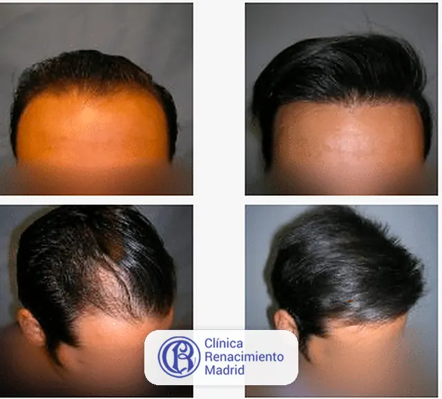 Caso real de implante de pelo en Marbella antes y después paciente 7 | Clínica Renacimiento Marbella