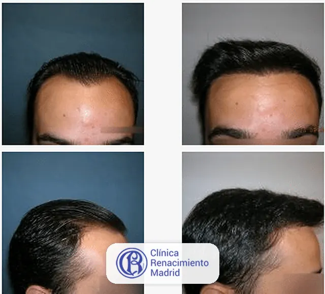 Caso real de implante de pelo en Marbella antes y después paciente 8 | Clínica Renacimiento Marbella