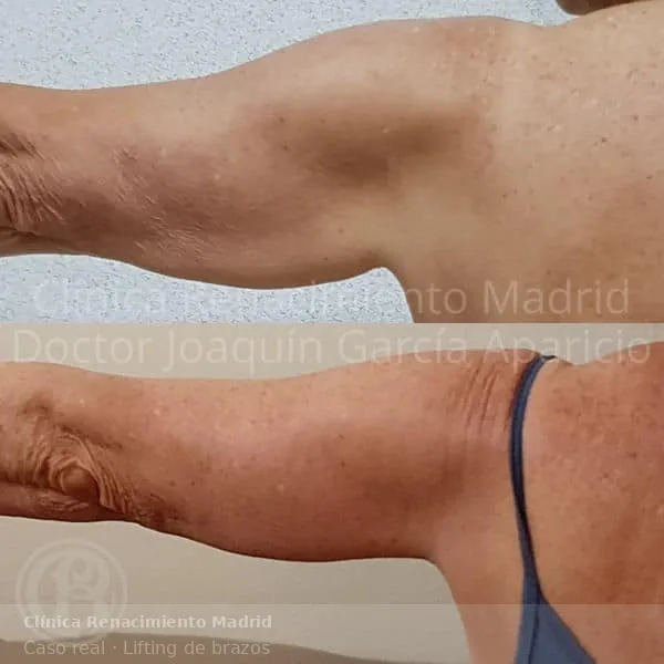 Antes y después de lifting de brazos en Clínica Renacimiento Marbella caso real 1