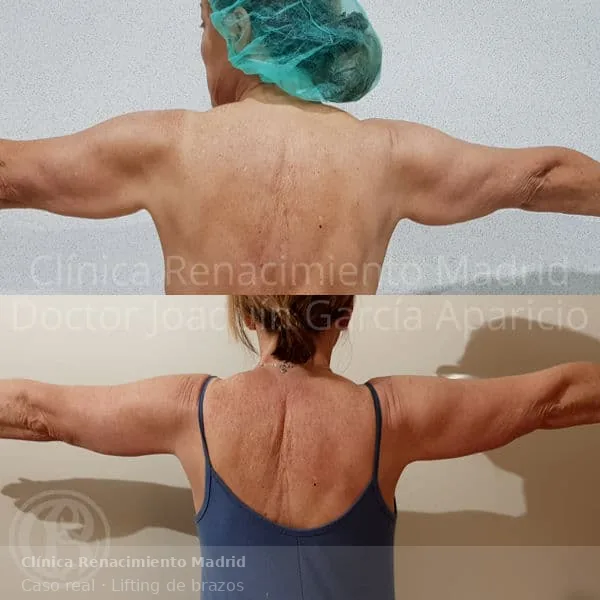 Caso real de braquioplastia o lifting de brazos en Clínica Renacimiento Marbella y Marbella