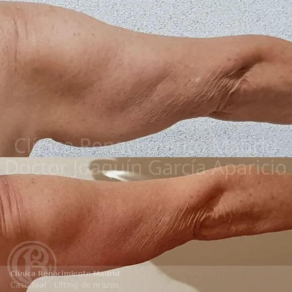 Antes y después de redefinición de brazos mediante braquioplastia en Marbella