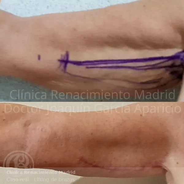Planificación y resultado de lifting de brazos con cicatriz controlada en Clínica Renacimiento