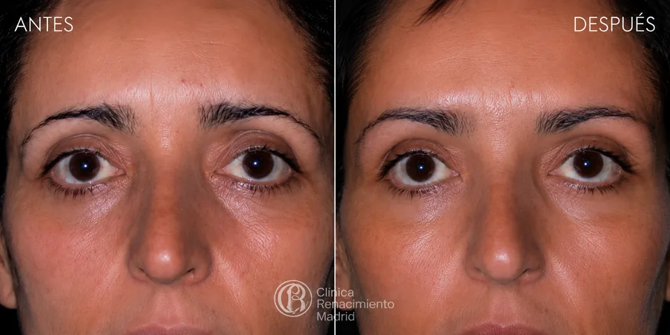 Caso real de lifting de cejas en Marbella antes y después zona de la mirada | Clínica Renacimiento Marbella
