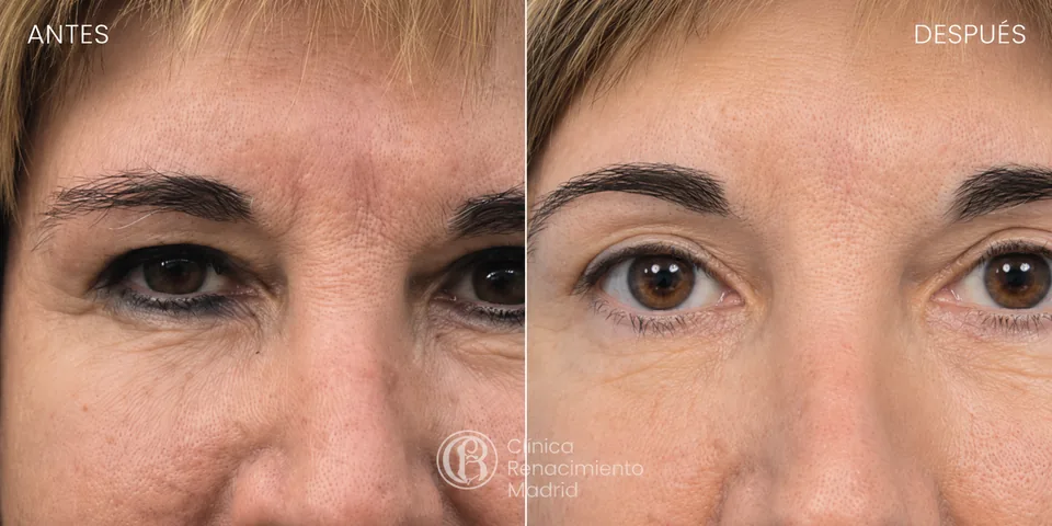 Antes y después de lifting de cejas en Marbella rejuvenecimiento de la mirada | Clínica Renacimiento Marbella