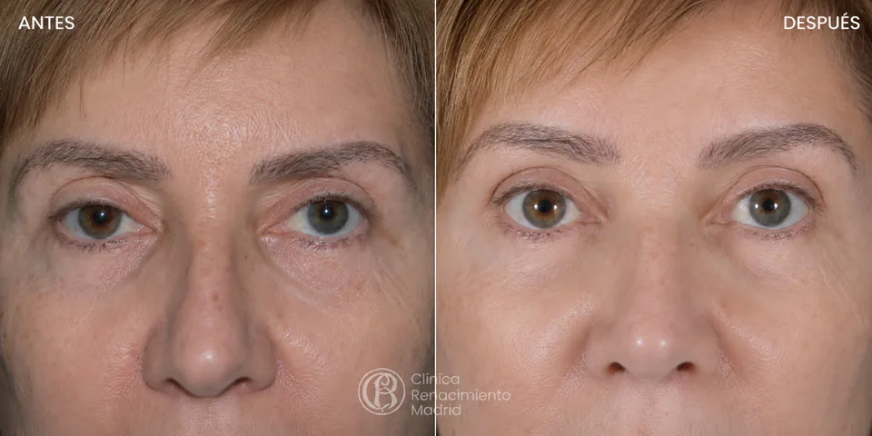 Resultado de lifting de cejas en Marbella comparativa antes y después | Clínica Renacimiento Marbella