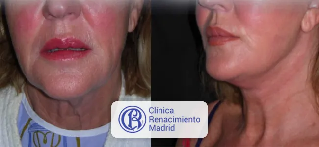 Antes y después de lifting de cuello en Marbella caso real 1 | Clínica Renacimiento Marbella