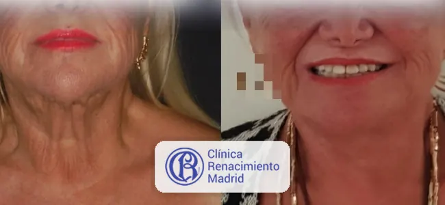Antes y después de lifting cervical en Marbella caso real 2 | Clínica Renacimiento Marbella