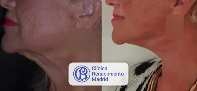 Resultado real de lifting de cuello en Marbella caso real 3 | Clínica Renacimiento Marbella