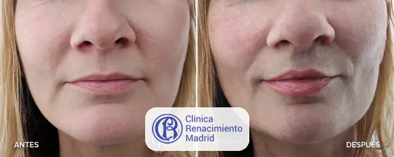 Caso real de Lifting de labios en Marbella antes y después paciente 1 | Clínica Renacimiento Marbella