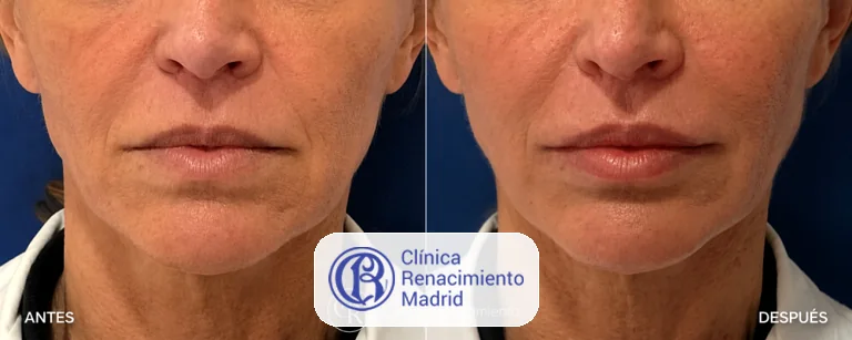 Caso real de Lip Lift en Marbella antes y después paciente 2 | Clínica Renacimiento Marbella