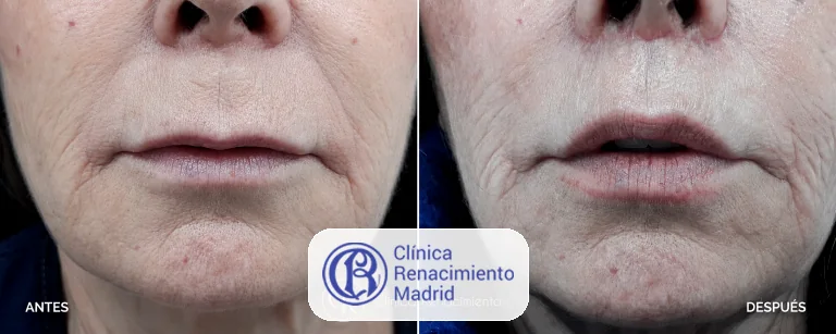 Caso real de lifting de labio superior en Marbella antes y después paciente 3 | Clínica Renacimiento Marbella