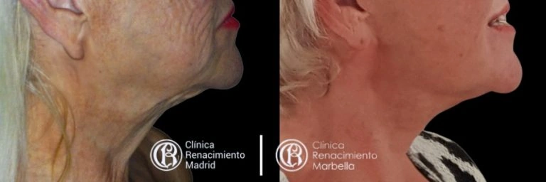 Caso real de lifting facial en Marbella antes y después, perfil de cuello y óvalo facial paciente 1 | Clínica Renacimiento Marbella