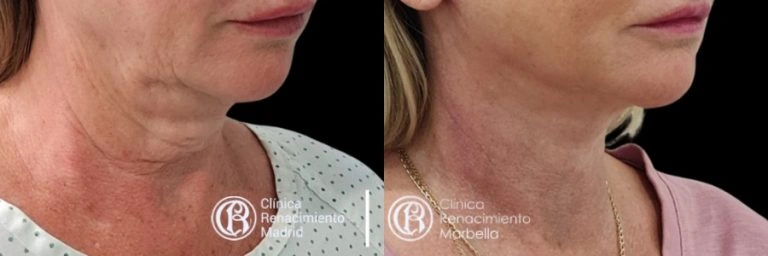 Caso real de lifting facial y cuello en Marbella antes y después paciente 2 | Clínica Renacimiento Marbella