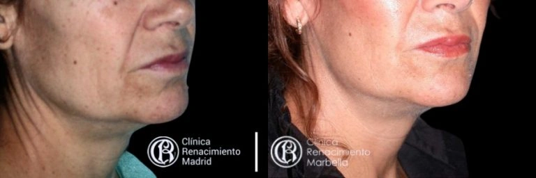 Comparativa real de lifting facial en Marbella antes y después paciente 3 | Clínica Renacimiento Marbella