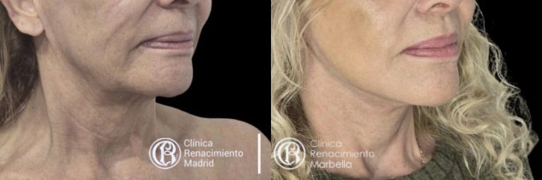 Antes y después de lifting facial en Marbella, redefinición del cuello y la línea mandibular paciente 4 | Clínica Renacimiento Marbella