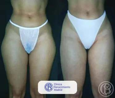 Caso real de lipoescultura integral HD y liposucción alta definición en Marbella antes y después caso 1 | Clínica Renacimiento Marbella