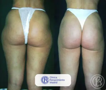 Caso real de lipoescultura integral HD y liposucción alta definición en Marbella antes y después caso 2 | Clínica Renacimiento Marbella