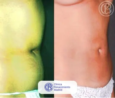 Caso real de lipoescultura integral HD y liposucción alta definición en Marbella antes y después caso 3 | Clínica Renacimiento Marbella