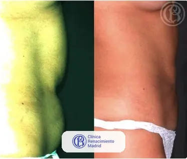 Caso real de lipoescultura integral HD y liposucción alta definición en Marbella antes y después caso 4 | Clínica Renacimiento Marbella