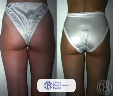 Caso real de lipoescultura integral HD y liposucción alta definición en Marbella antes y después caso 5 | Clínica Renacimiento Marbella