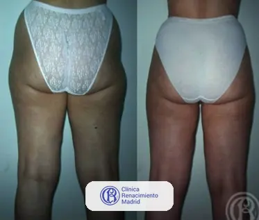 Caso real de lipoescultura integral HD y liposucción alta definición en Marbella antes y después caso 6 | Clínica Renacimiento Marbella
