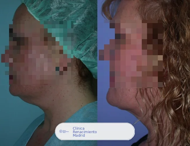 Caso real de lipoescultura de papada en Marbella antes y después | Clínica Renacimiento Marbella