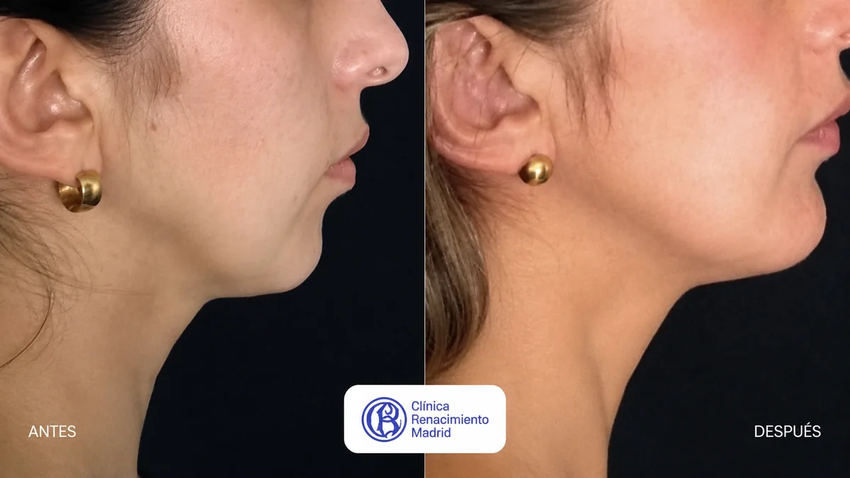 Caso real de cirugía de mentón en Marbella antes y después, perfil femenino con mejora de la línea mandibular | Clínica Renacimiento Marbella
