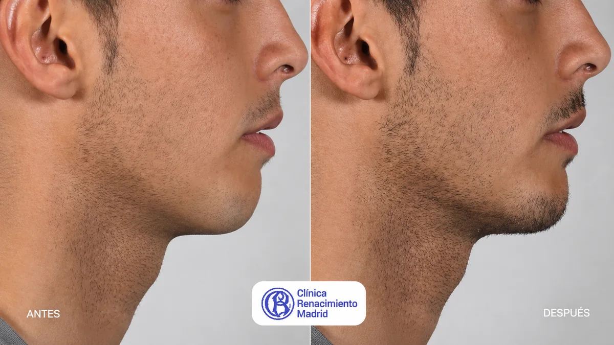 Caso real de mentoplastia masculina en Marbella antes y después, perfil y mentón proporcionado | Clínica Renacimiento Marbella