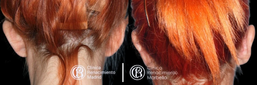Caso real de Otoplastia en Marbella antes y después paciente 1 | Clínica Renacimiento Marbella