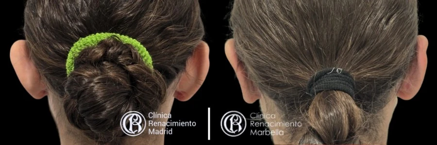 Caso real de Otoplastia en Marbella antes y después paciente 2 | Clínica Renacimiento Marbella