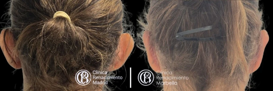 Caso real de Otoplastia en Marbella antes y después paciente 3 | Clínica Renacimiento Marbella