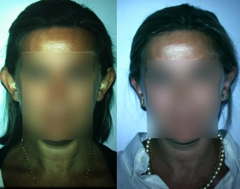Caso real de Otoplastia en Marbella antes y después paciente 4 | Clínica Renacimiento Marbella