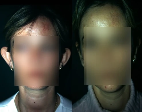Caso real de Otoplastia en Marbella antes y después paciente 5 | Clínica Renacimiento Marbella