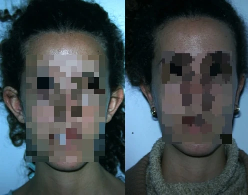 Caso real de Otoplastia en Marbella antes y después paciente 6 | Clínica Renacimiento Marbella