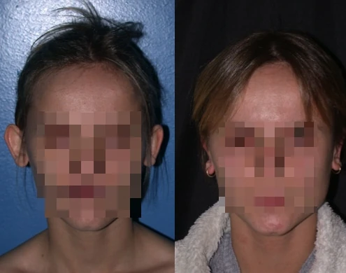 Caso real de Otoplastia en Marbella antes y después paciente 7 | Clínica Renacimiento Marbella