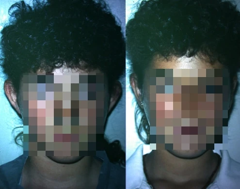 Caso real de Otoplastia en Marbella antes y después paciente 8 | Clínica Renacimiento Marbella